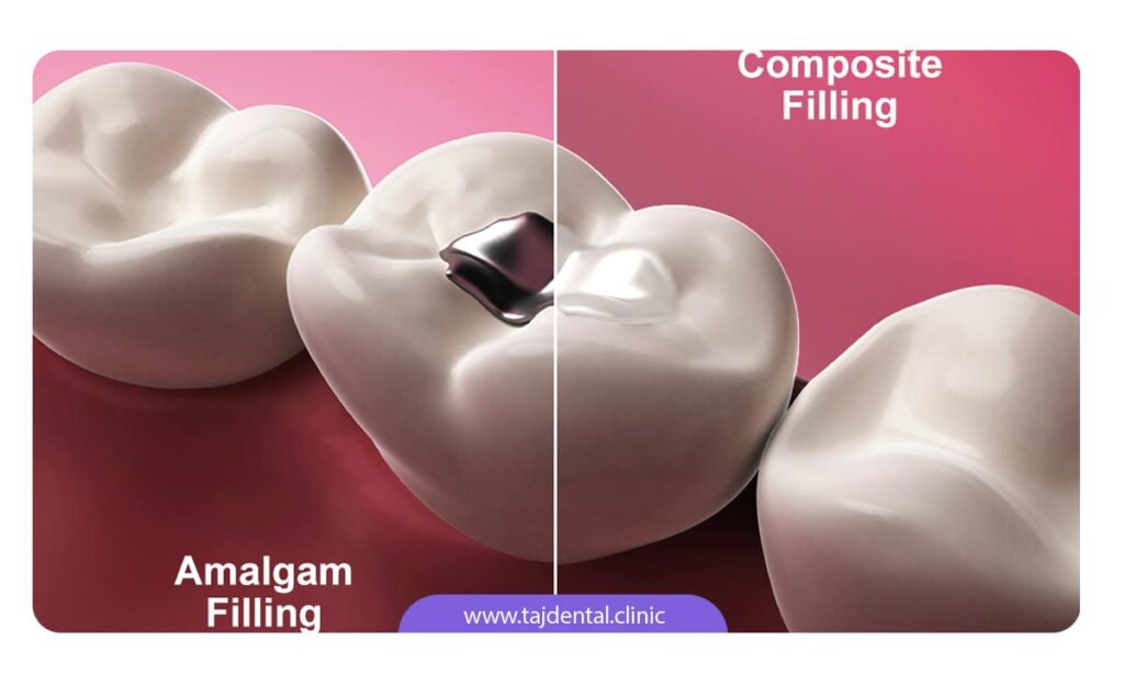 تصویر مقایسه پر کردن دندان با مواد آمالگام و کامپوزیت