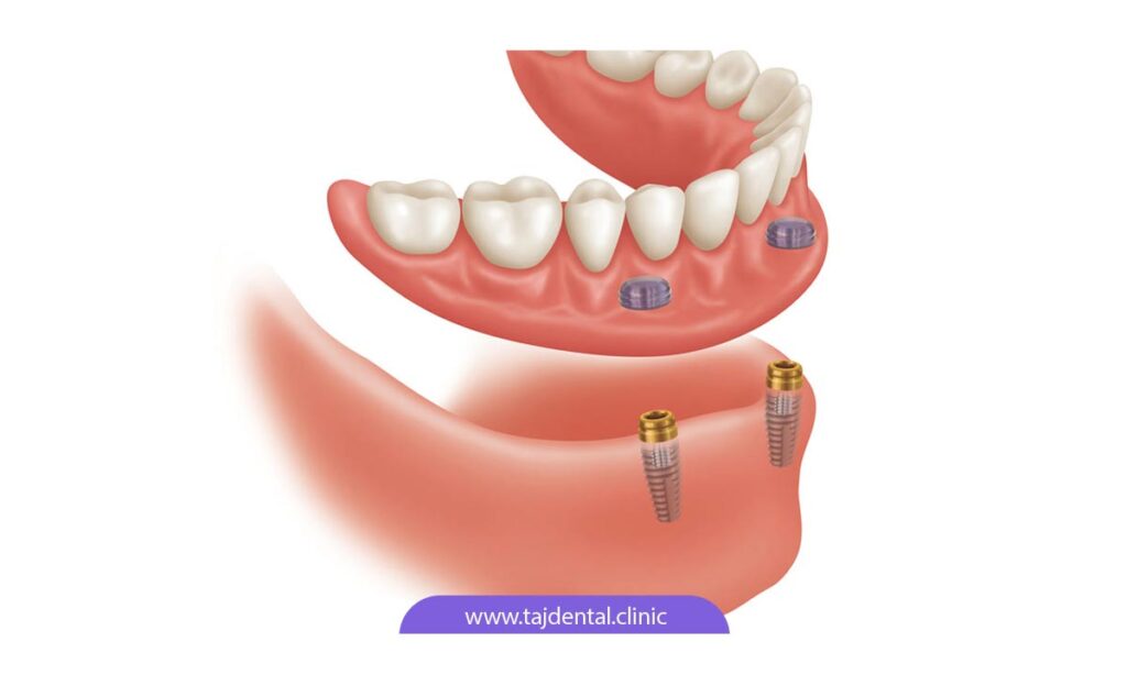 تصویر شماتیک دندان مصنوعی ثابت بر پایه ایمپلنت