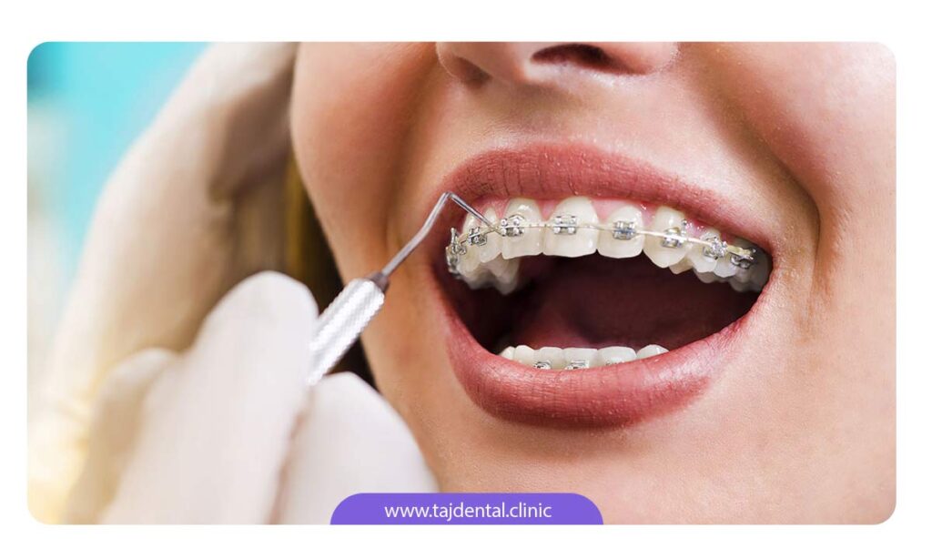 تصویر شخصی با دندان های ارتودنسی شده در حال معاینه توسط ارتودنتیست
