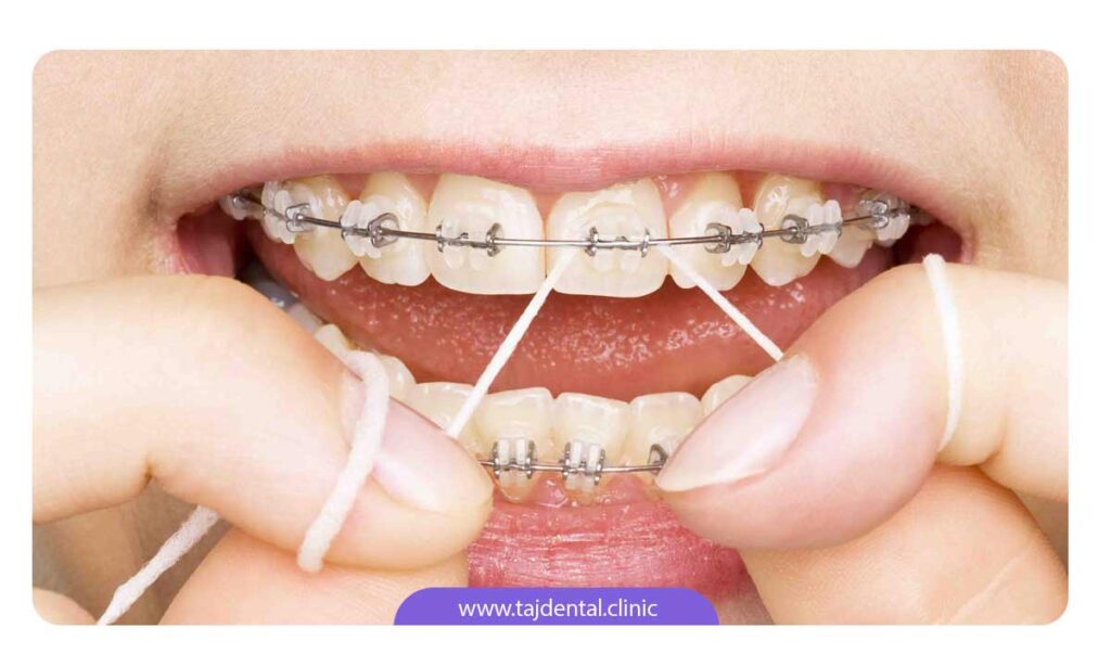 تصویر شخصی در حال کشیدن نخ دندان بعد از ارتودنسی