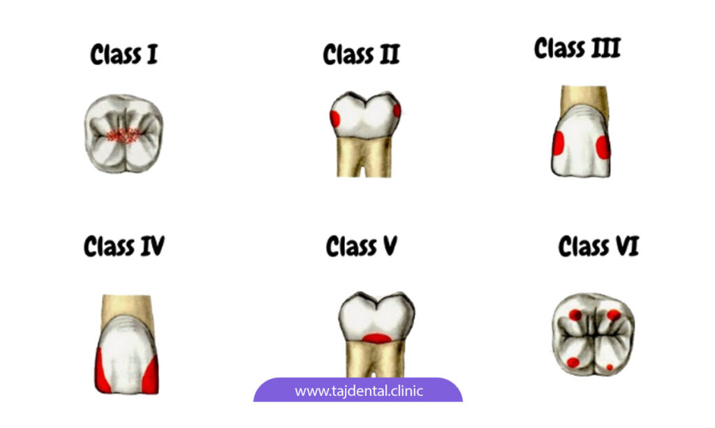 تصویر شماتیک از انواع کلاس های پوسیدگی دندان