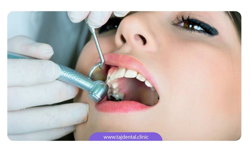 تصویر جرمگیری دندان توسط دندانپزشک