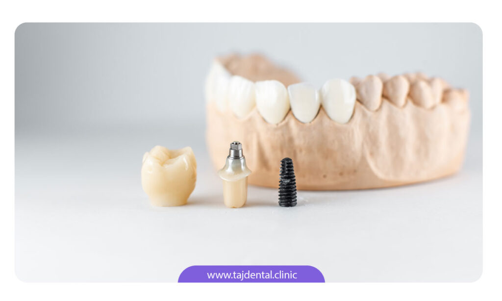 تصویر ماکت دندان های فک پایین و پایه و اباتمنت و روکش ایمپلنت دندان