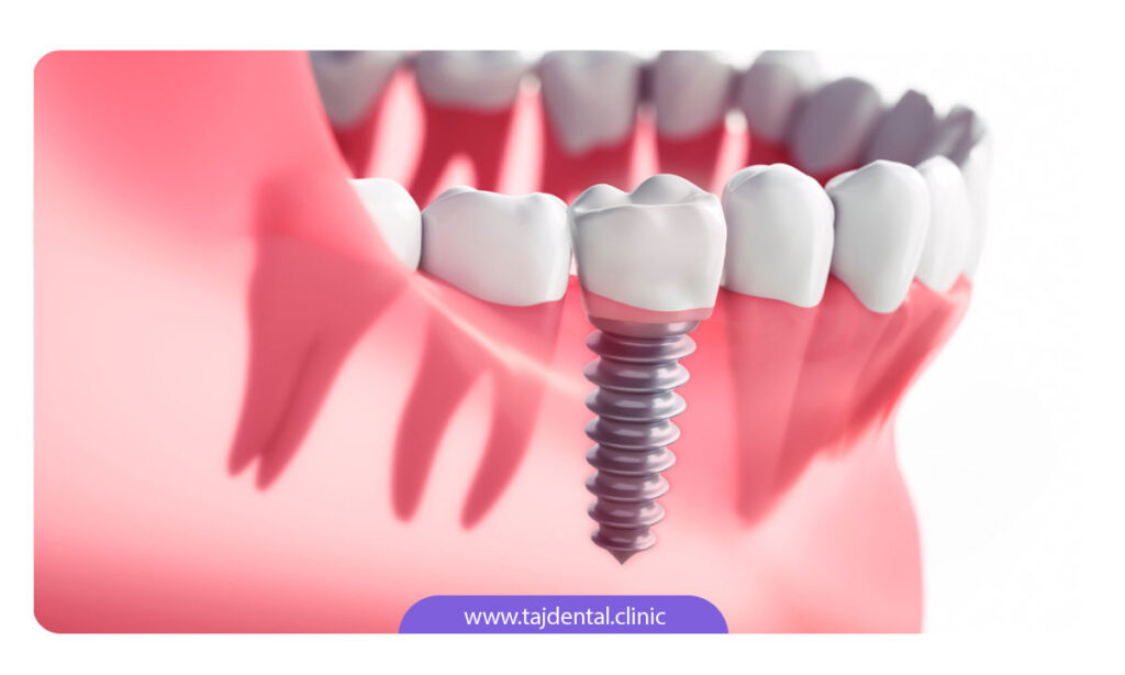 تصویر شماتیک از ایمپلنت دندان