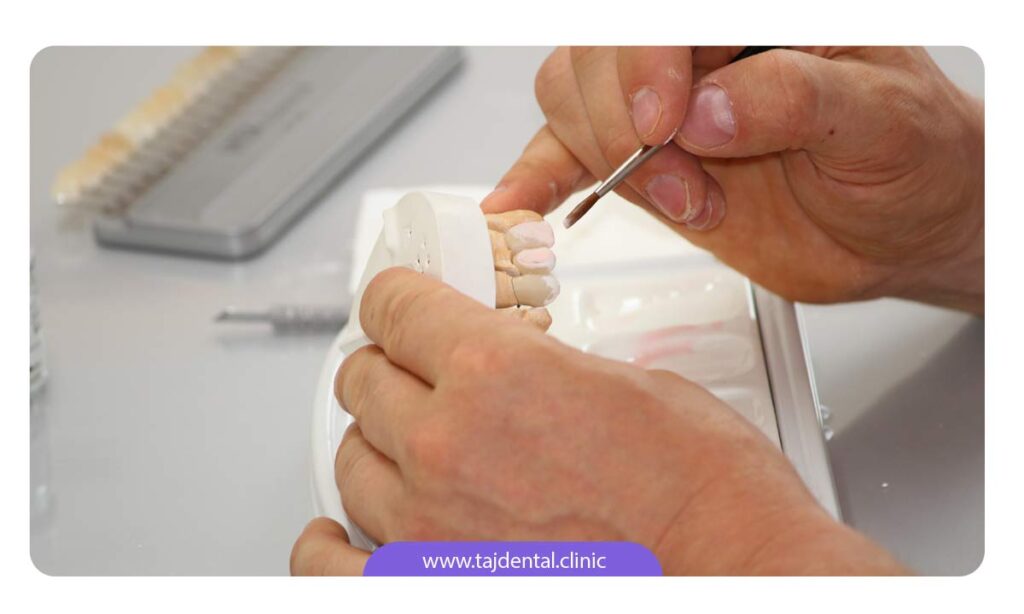 تصویر نصب لمینت سرامیکی دندان بر روی ماکت