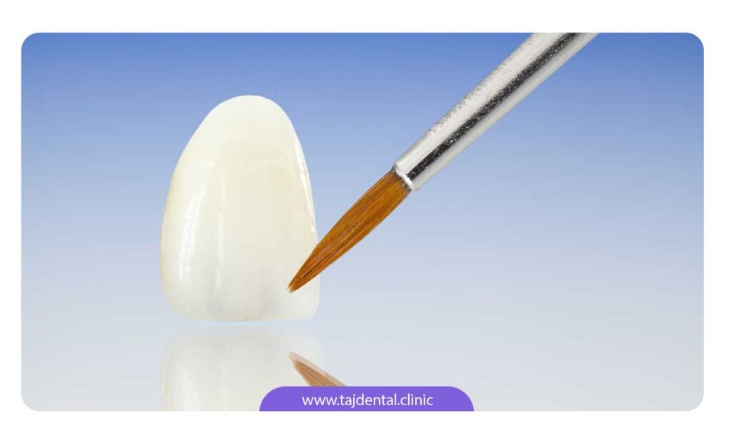 تصویر یک لمینت سرامیکی دندان به همراه قلم مو