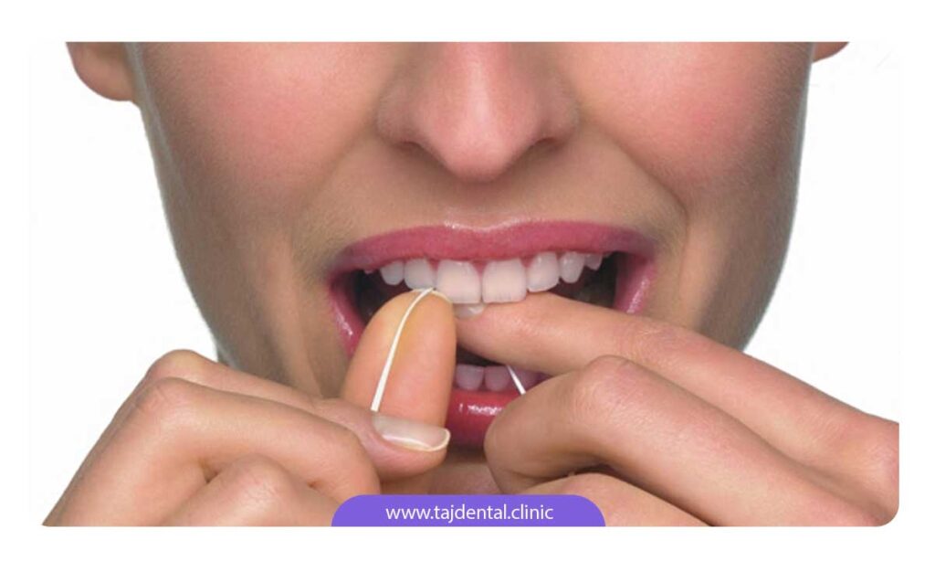 تصویر کشیدن نخ دندان بین دندان های لمینت شده