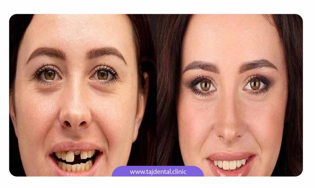 تصویر خانمی قبل و بعد از ایمپلنت دندان جلو
