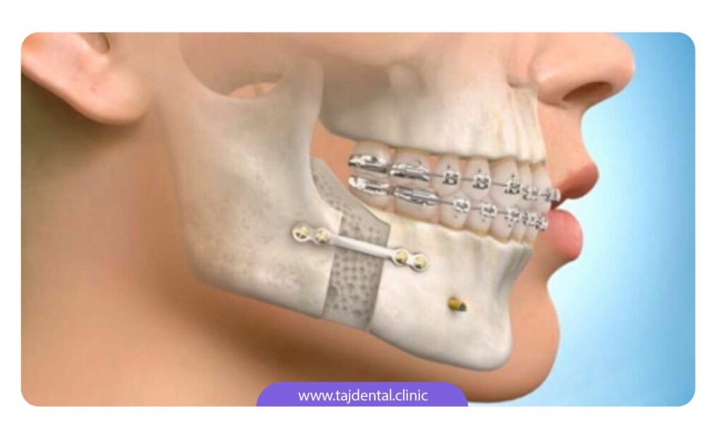 تصویر نیمرخ استخوان فک با دندان های ارتودنسی شده