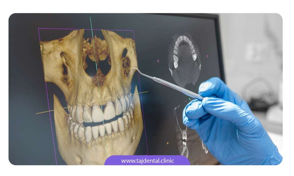 تصویر استخوان فک روی صفحه مانیتور دندانپزشک