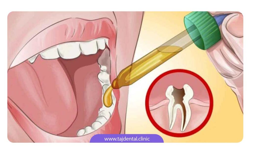 تصویر شماتیک از ریختن محلول برای روی دندان جهت کاهش دندان درد