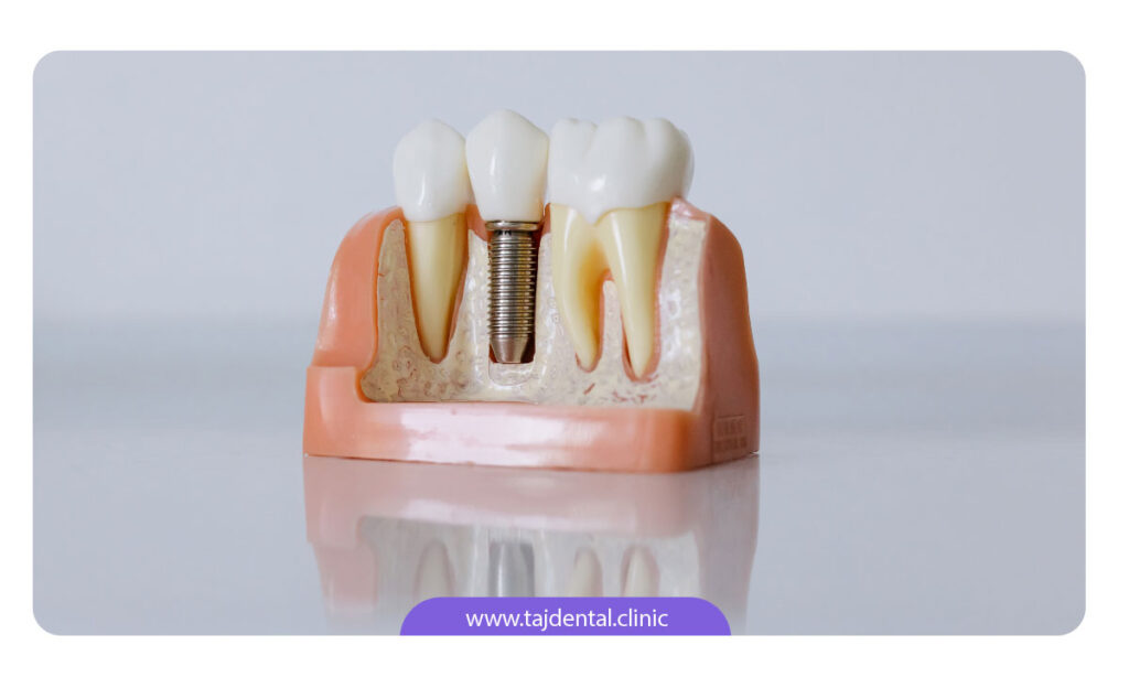 تصویر ماکت ایمپلنت دندان