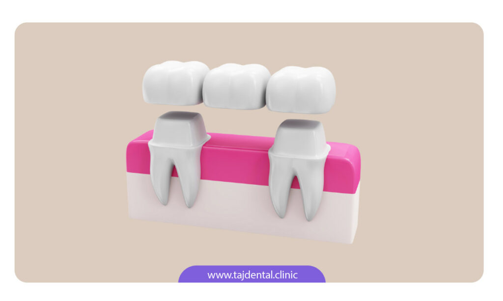 تصویر شماتیک از بریج دندان