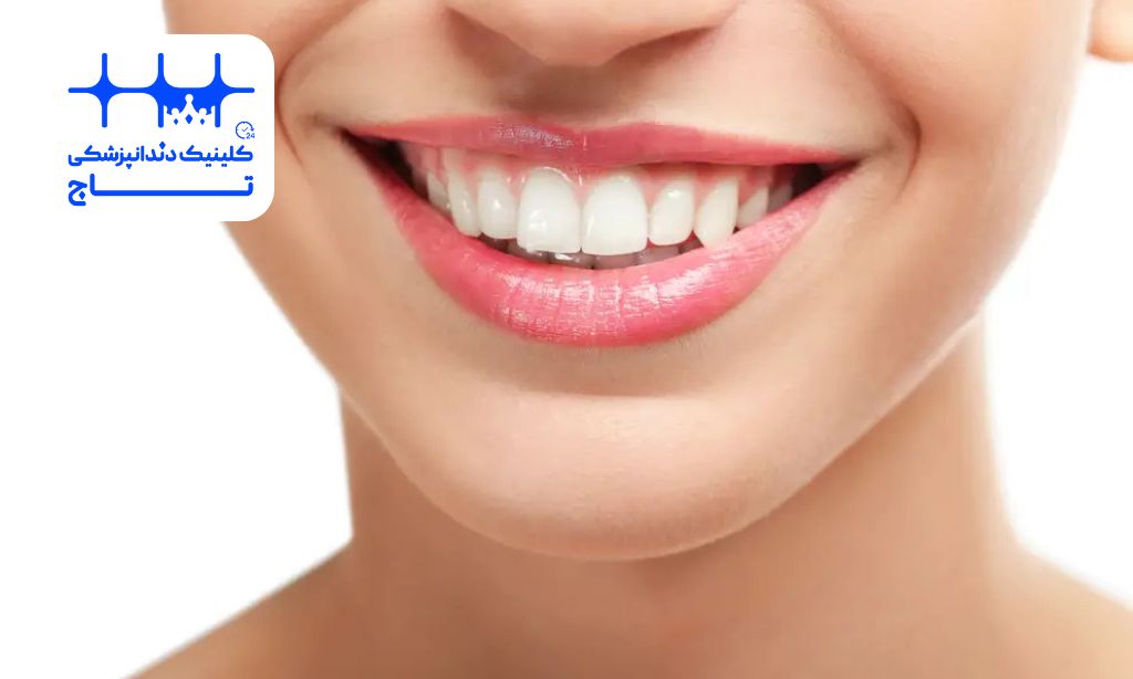 اصلاح دندان نیش بدون ارتودنسی