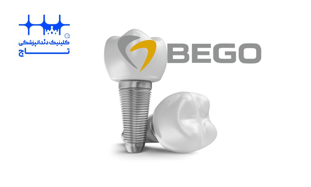ایمپلنت bego