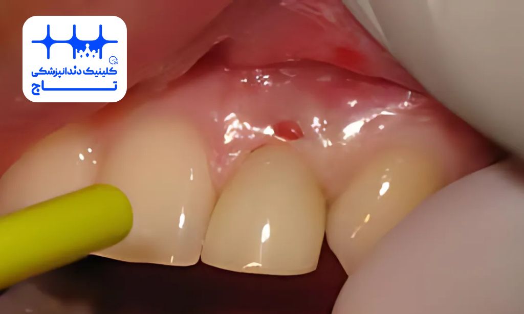 سوراخ شدن لثه