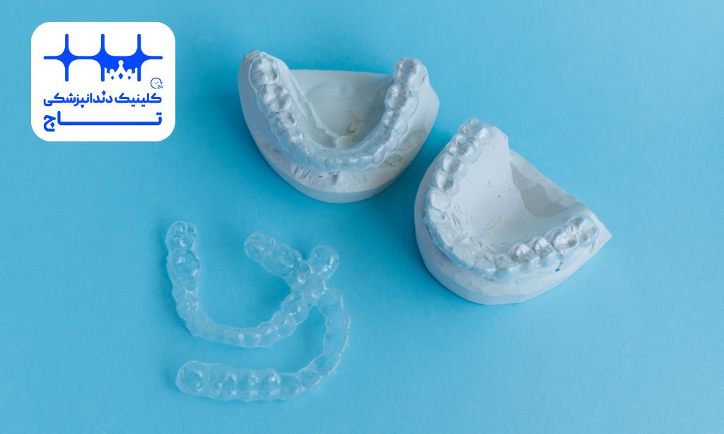 قالب گیری ارتودنسی