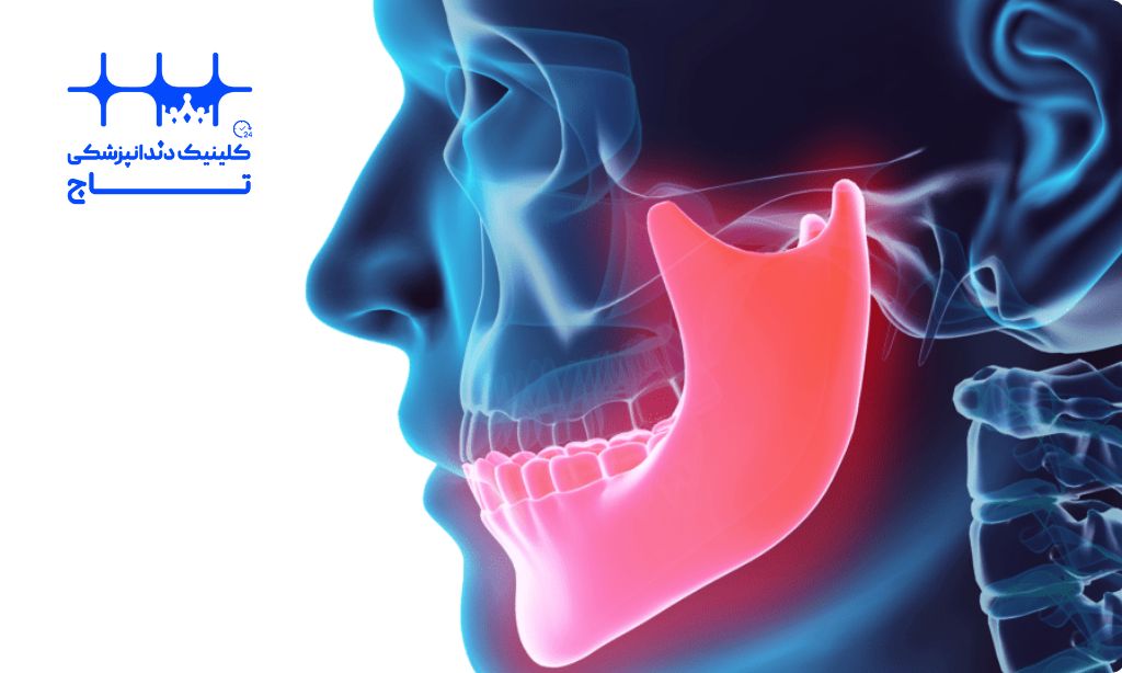 اختلال مفصل گیجگاهی فکی