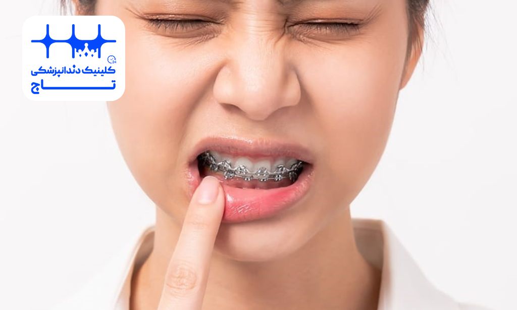 شکستن براکت و سیم ارتودنسی