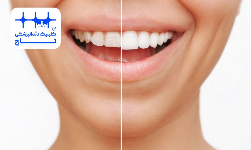 لمینت فلدسپاتیک