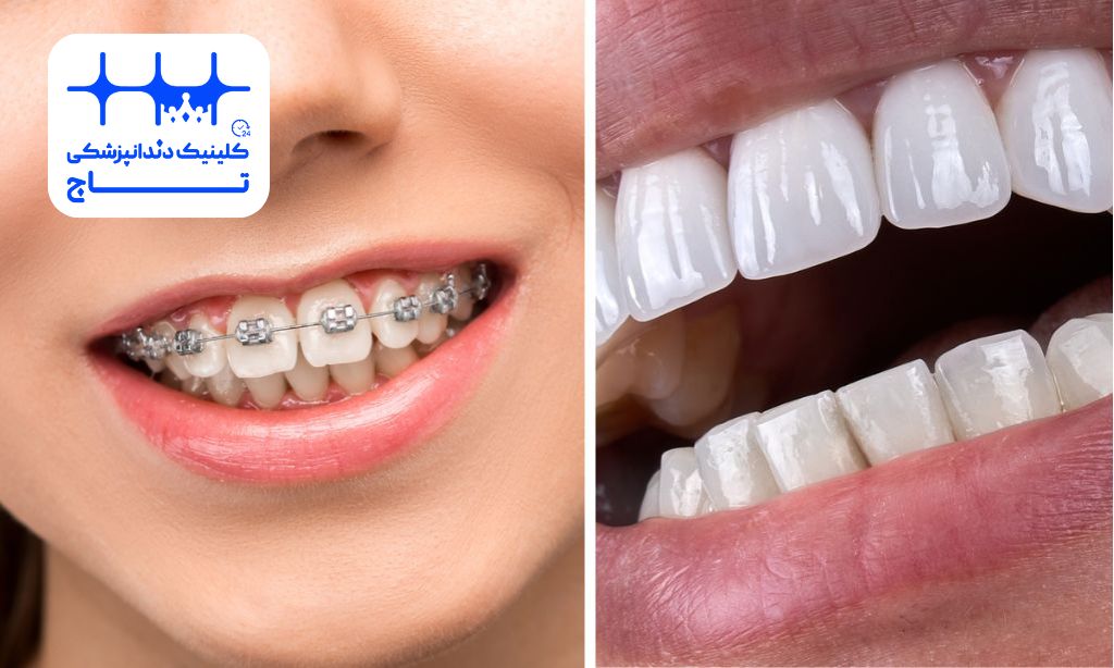 کامپوزیت بهتر است یا ارتودنسی
