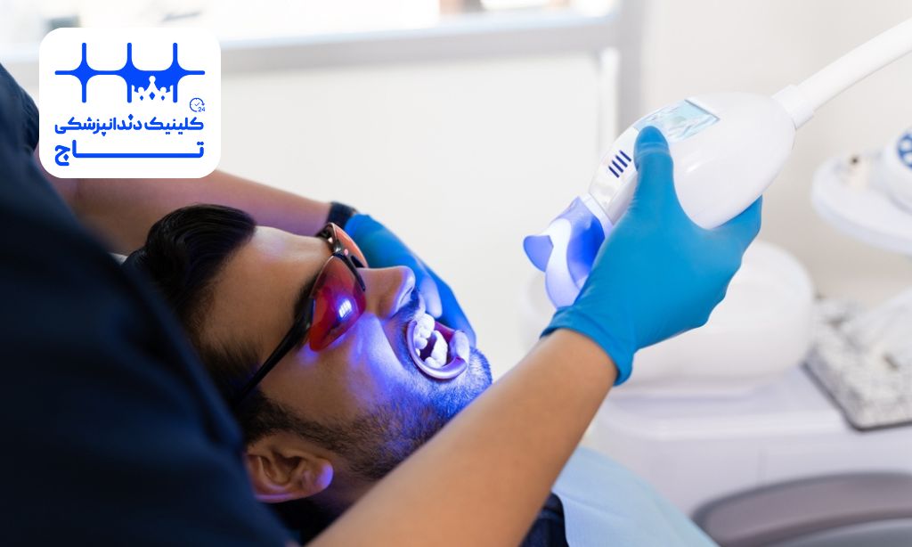 بلیچینگ با لیزر