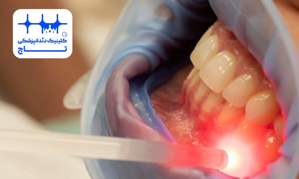 رفع تیرگی لثه با لیزر