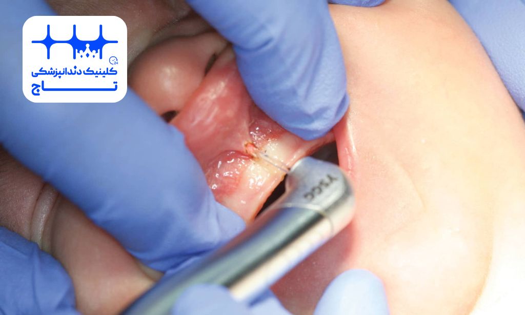 فرنکتومی با لیزر