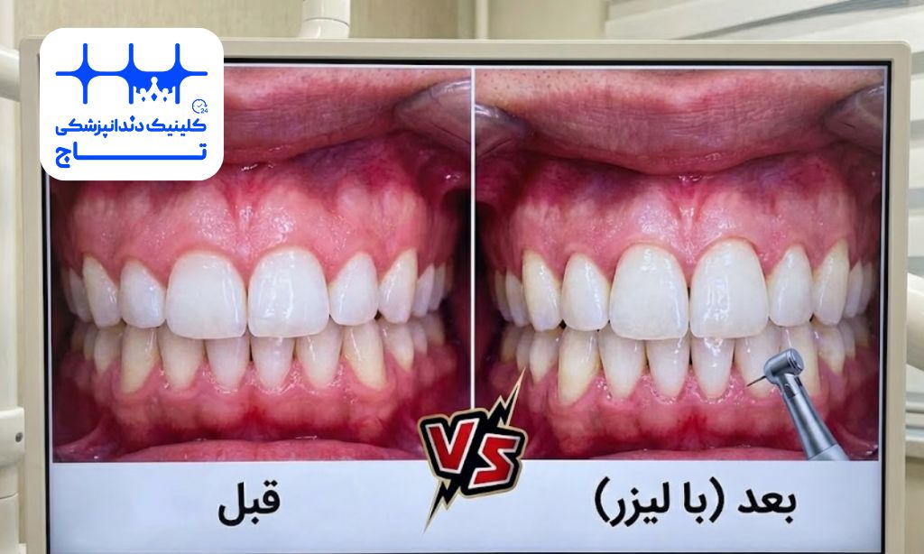 لیفت لثه با لیزر